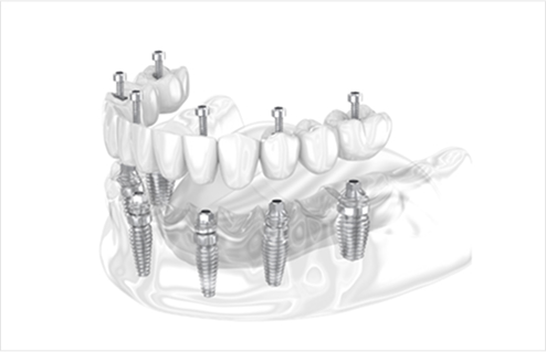 전악(전체) 임플란트